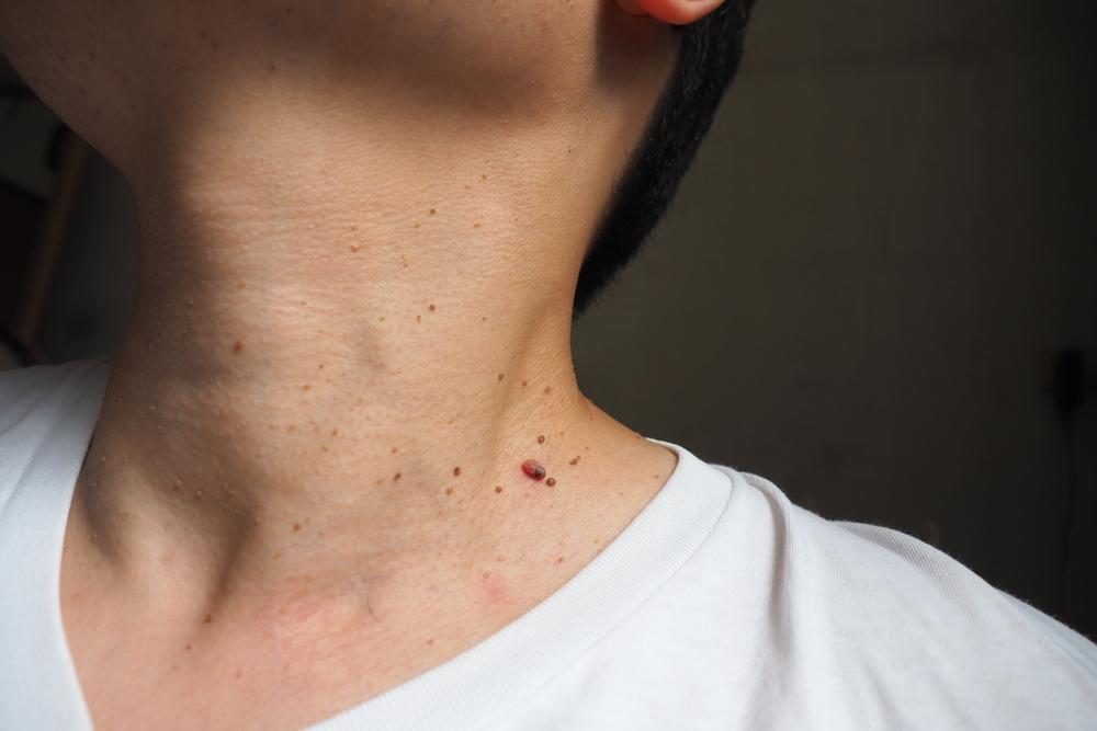 De ce apar papiloamele. Cauze posibile și soluții pe care le ai la îndemână dacă vrei să scapi de ele