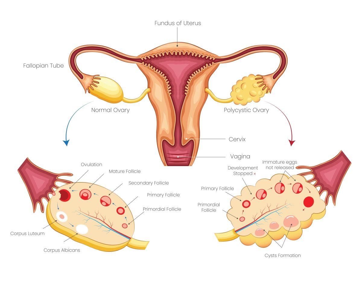 Tot ce trebuie să știi despre sindromul ovarelor polichistice