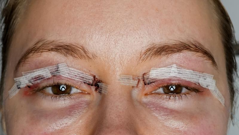Benzile adezive pentru ochi s-au transformat dintr-un truc rapid în coșmar. Ce au pățit femeile care le-au folosit