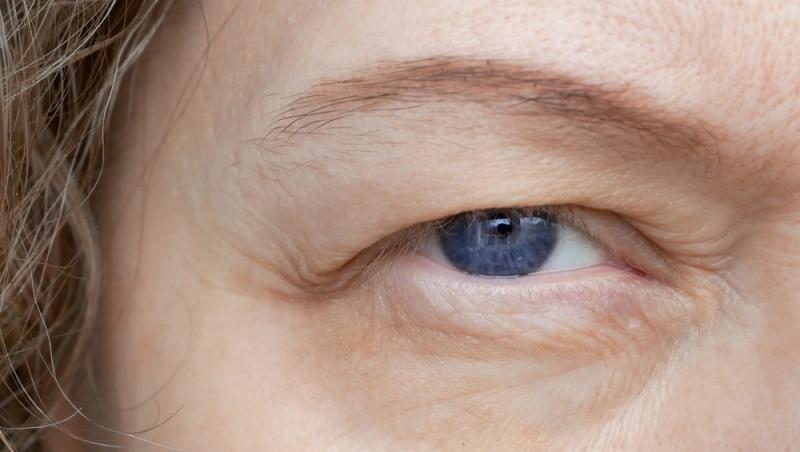 Benzile adezive pentru ochi s-au transformat dintr-un truc rapid în coșmar. Ce au pățit femeile care le-au folosit