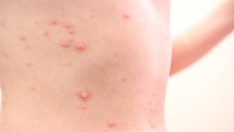 Erupție de varicelă