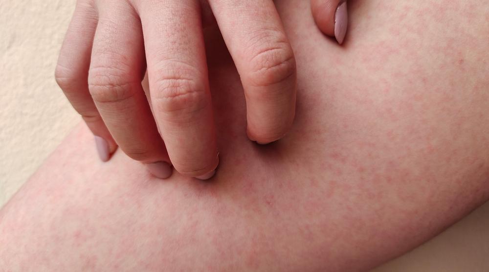 degete care scarpină o urticarie pe picior close up