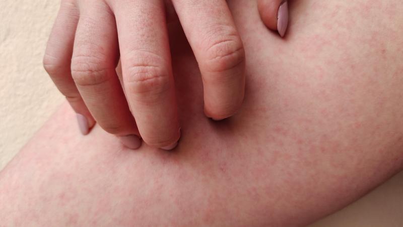 degete care scarpină o urticarie pe picior close up