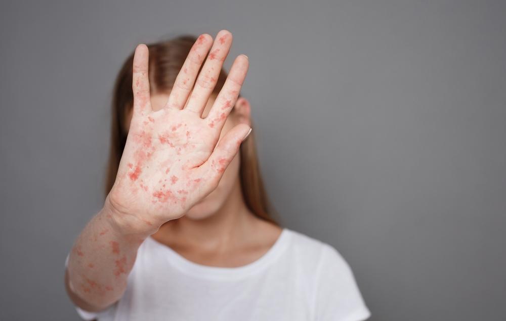 fată care arată o palmă cu erupție de rujeolă