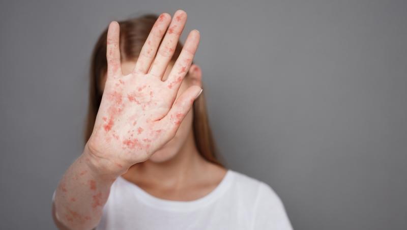 fată care arată o palmă cu erupție de rujeolă