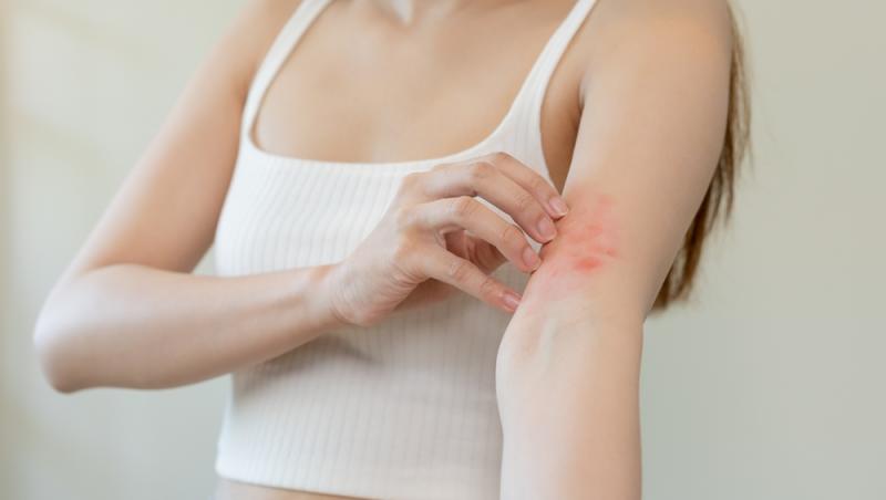 o femeie care scarpină o iritație roșie pe braț
