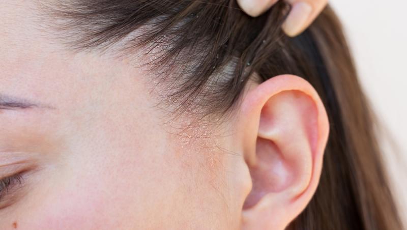 Dermatită seboreică