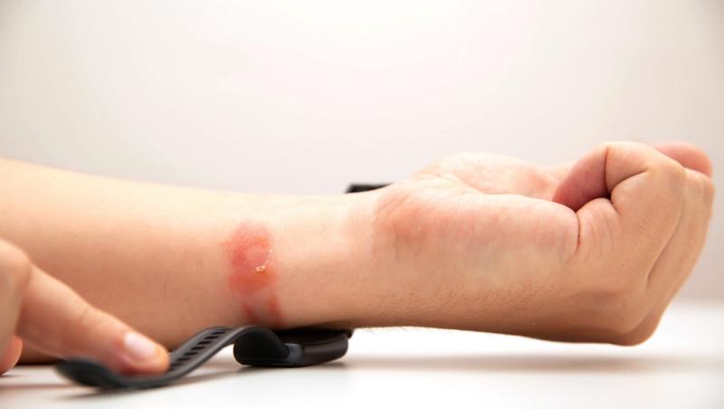o persoană cu dermatită de contact la încheietura mâinii de la o brățară de silicon
