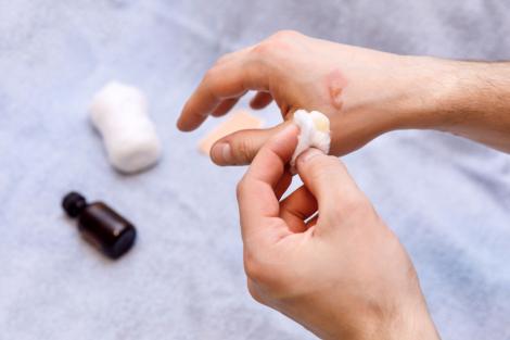 Ce să pui pe o rană ca să se vindece mai repede: 6 soluții care ajută rana să se închidă rapid