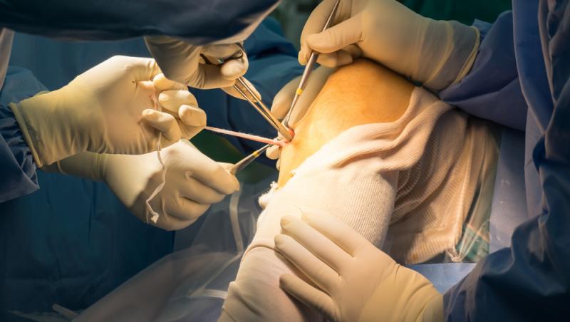 O nouă procedură estetică a câștigat teren. De ce apelează tot mai multe femei la ajutorul medicilor din Turcia