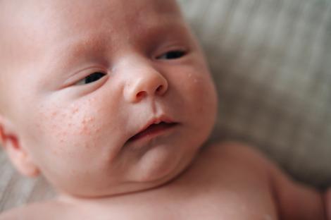 5 probleme ale pielii bebelușilor care pot apărea în primul an de viață