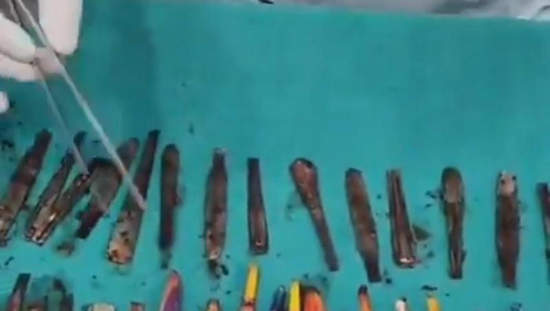 Un bărbat din India și-a potolit foamea cu periuțe de dinți și tacâmuri. Imagini cu ce au putut găsi doctorii în stomacul lui