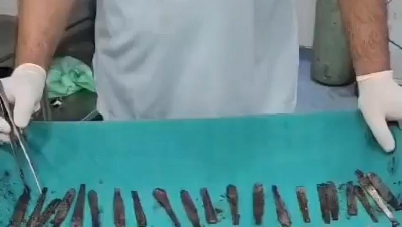 Un bărbat din India și-a potolit foamea cu periuțe de dinți și tacâmuri. Imagini cu ce au putut găsi doctorii în stomacul lui