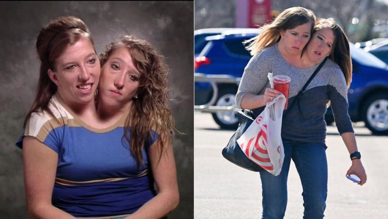 colaj abby si brittany hensel