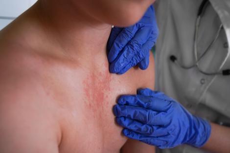 Decizie controversată &icirc;n SUA, &icirc;n plină epidemie de rujeolă! Se schimbă modul &icirc;n care sunt raportate decesele
