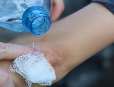 Greșeala pe care mulți rom&acirc;ni o fac atunci c&acirc;nd &icirc;și dezinfectează rănile. Un medic explică ce poate &icirc;nt&acirc;rzia vindecarea