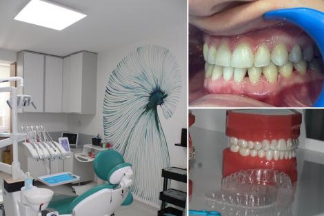 (P) C&acirc;t durează un tratament cu alignere invizibile Spark și care sunt etapele lui? Ghid explicat de medicii Dental Science