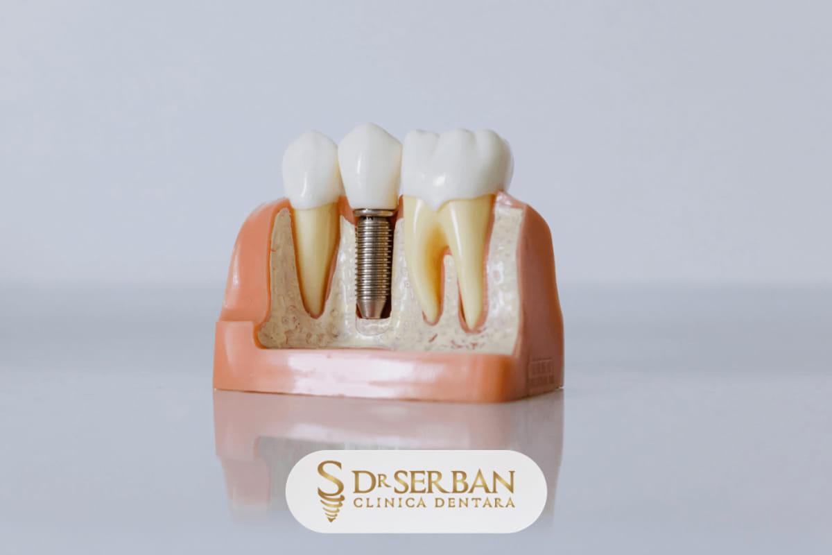 (P) Clinica Stomatologică Dr. Șerban București: ce preț are un implant dentar și de ce nu este o sumă fixă?