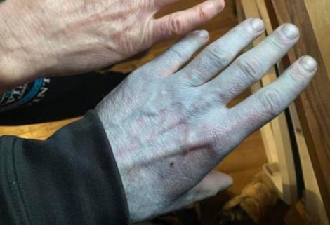 Un bărbat a ajuns la spital după ce pielea i s-a făcut albastră pe tot corpul. Ce au constatat medicii