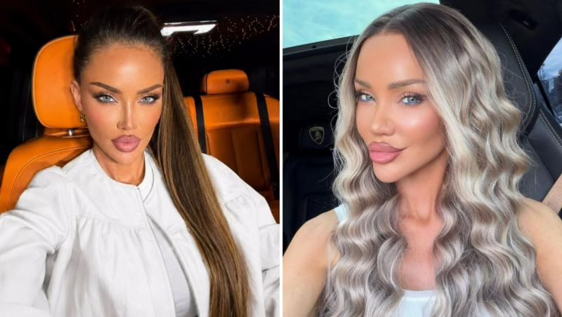 Cum arată Bianca Drăgușanu după ce și-a operat urechile. Vedeta a arătat rezultatul după intervenția controversată