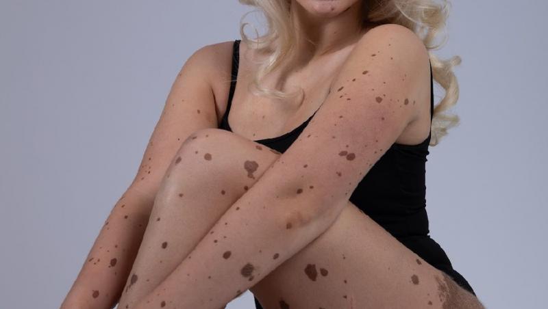 Cum arată în costum de baie tânăra acoperită de semne din naștere pe tot corpul. Oamenii nu se pot opri din privit