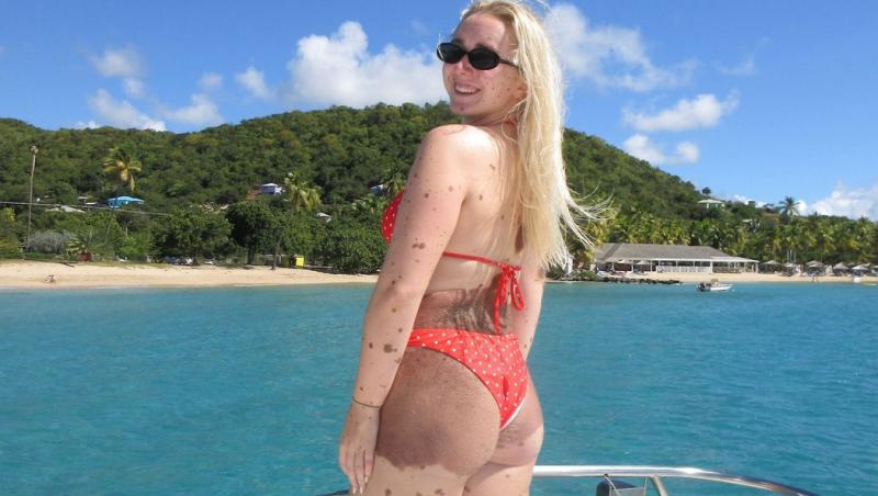 Cum arată în costum de baie tânăra acoperită de semne din naștere pe tot corpul. Oamenii nu se pot opri din privit