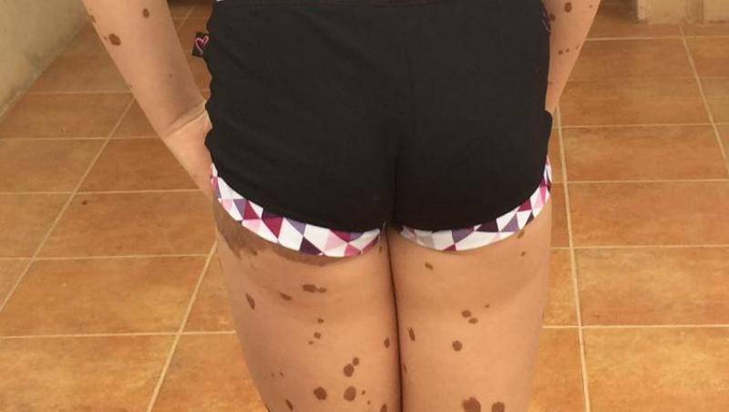 Cum arată în costum de baie tânăra acoperită de semne din naștere pe tot corpul. Oamenii nu se pot opri din privit