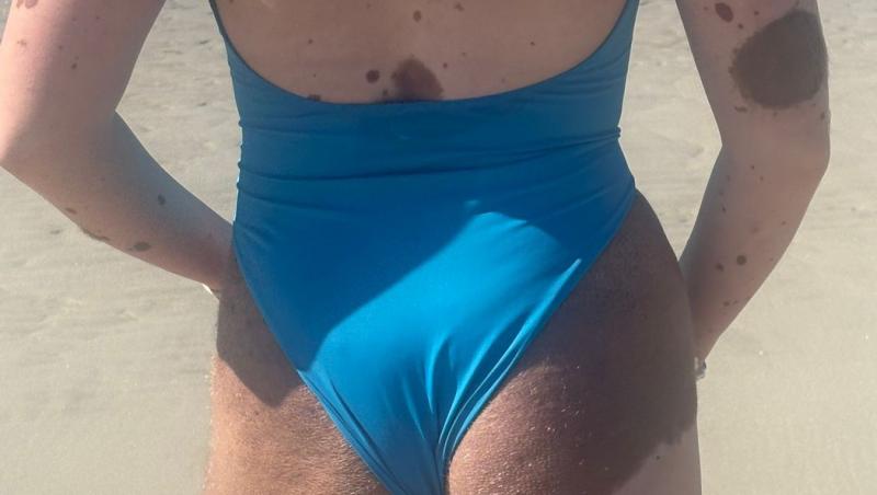 Cum arată în costum de baie tânăra acoperită de semne din naștere pe tot corpul. Oamenii nu se pot opri din privit