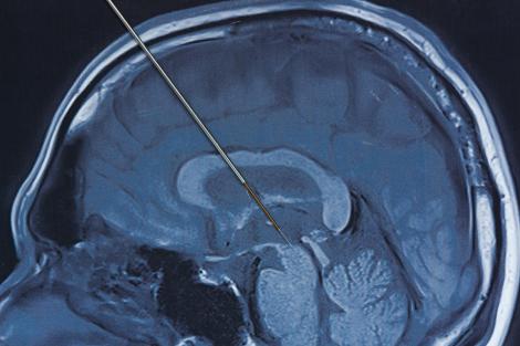 Implantul cerebral mai subțire dec&acirc;t un ac. Dispozitivul inedit care poate rezolva 3 probleme medicale &icirc;n același timp