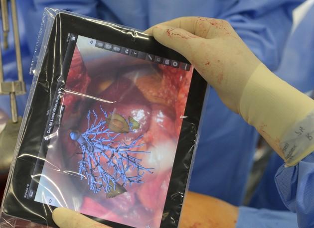 Operatie de ficat, realizata cu o aplicatie iPad