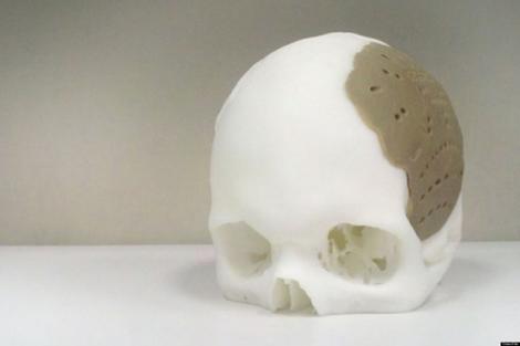 VIDEO! Un implant 3D de craniu? Sigur, cu succes!