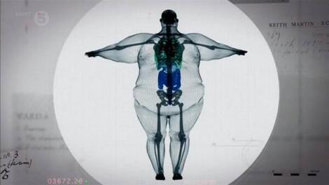 ȘOCANT! Vei ține dietă începând de acum: Așa arată radiografia unui obez!