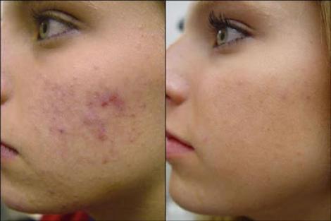 Ai pete și cicatrici inestetice pe față sau pe corp? Scapă de ele cu o cremă 100% naturală, preparată în casă