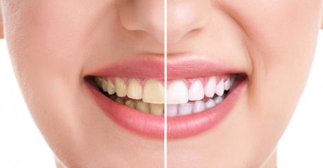 Reţeta naturală care albeşte dinţii în 30 de zile, fără să fie afectat smalţul! Rezultatul e garantat