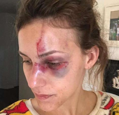Revoltător! Un sportiv celebru şi-a desfigurat iubita după o postare pe Instagram! Imagini halucinante au fost făcute publice