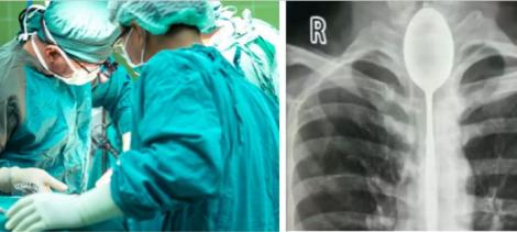 Caz ȘOCANT în lumea medicală! Un bărbat este operat de urgență după ce a stat 1 an de zile cu o lingură înfiptă în gât. Declarația bărbatului a îngrozit medicii