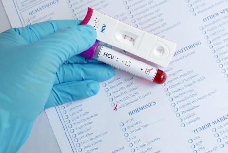 28 iulie, Ziua Mondială a Luptei Împotriva Hepatitei. Românii au parte de testare gratuită