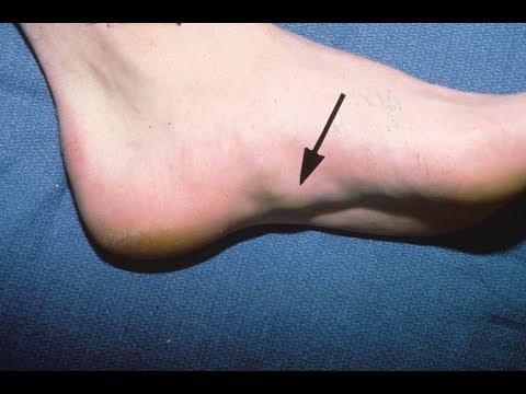 umflaturi pe talpa piciorului tratament pt guta
