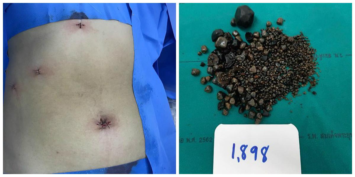 AtenÈ›ie O Femeie Care Acuza In PermanenÈ›Äƒ Dureri De Stomac A Mers La Medic È™i A Ajuns Direct In OperaÈ›ie Antena 1