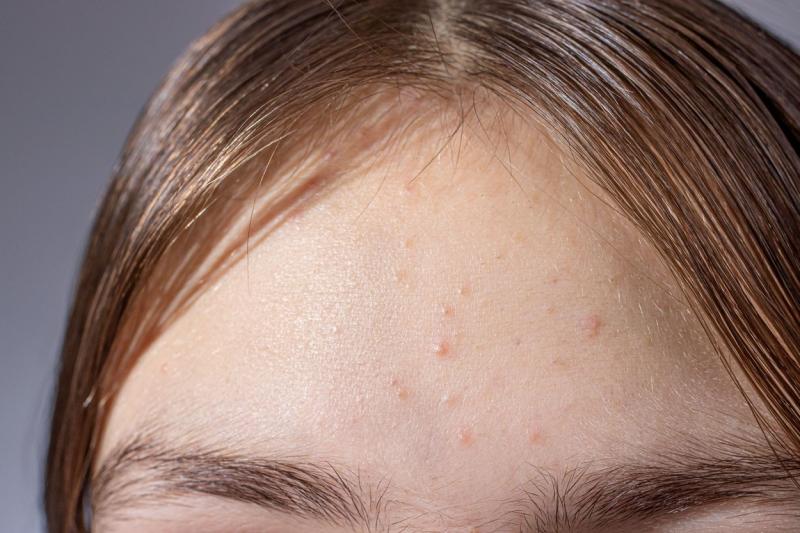 imagine ilustrativă cu puncte albe pe sub ochi (milia)