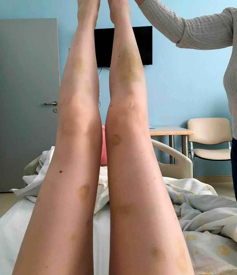 Rănile tinerei Darya Mukhina, după atac