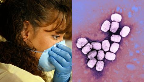 Zeci de cazuri suspecte de infectare la om cu "variola maimuței". Care sunt simptomele raportate în micile focare din Europa