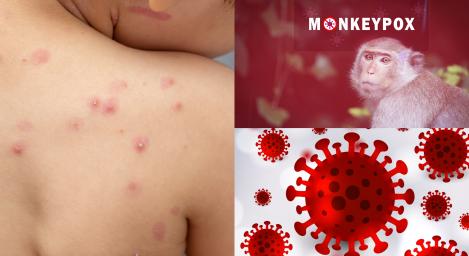 Câte cazuri de variola maimuței au fost înregistrate la nivel mondial. Numărul e de cinci ori mai mare comparativ cu 20 mai