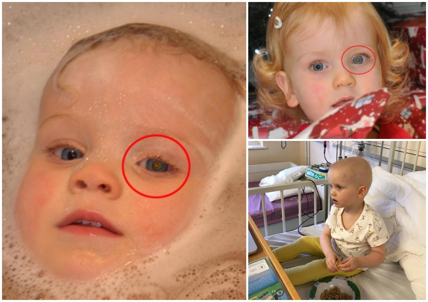 O mamă a privit pozele cu fetița ei și a văzut că aceasta are un semn ciudat la ochi. Medicii i-au dat un diagnostic dureros