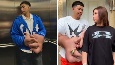 Povestea impresionantă a unui bărbat din Filipine ale cărui mâini cântăresc aproape 9 kilograme. Ce spune despre viața sa amoroasă