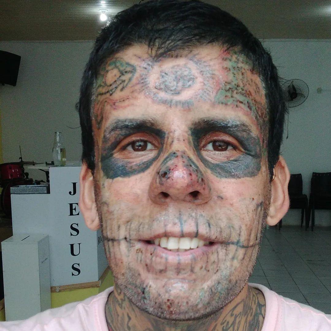 Leandro de Souza în timpul de procedurile de îndepărtare a tatuajelor