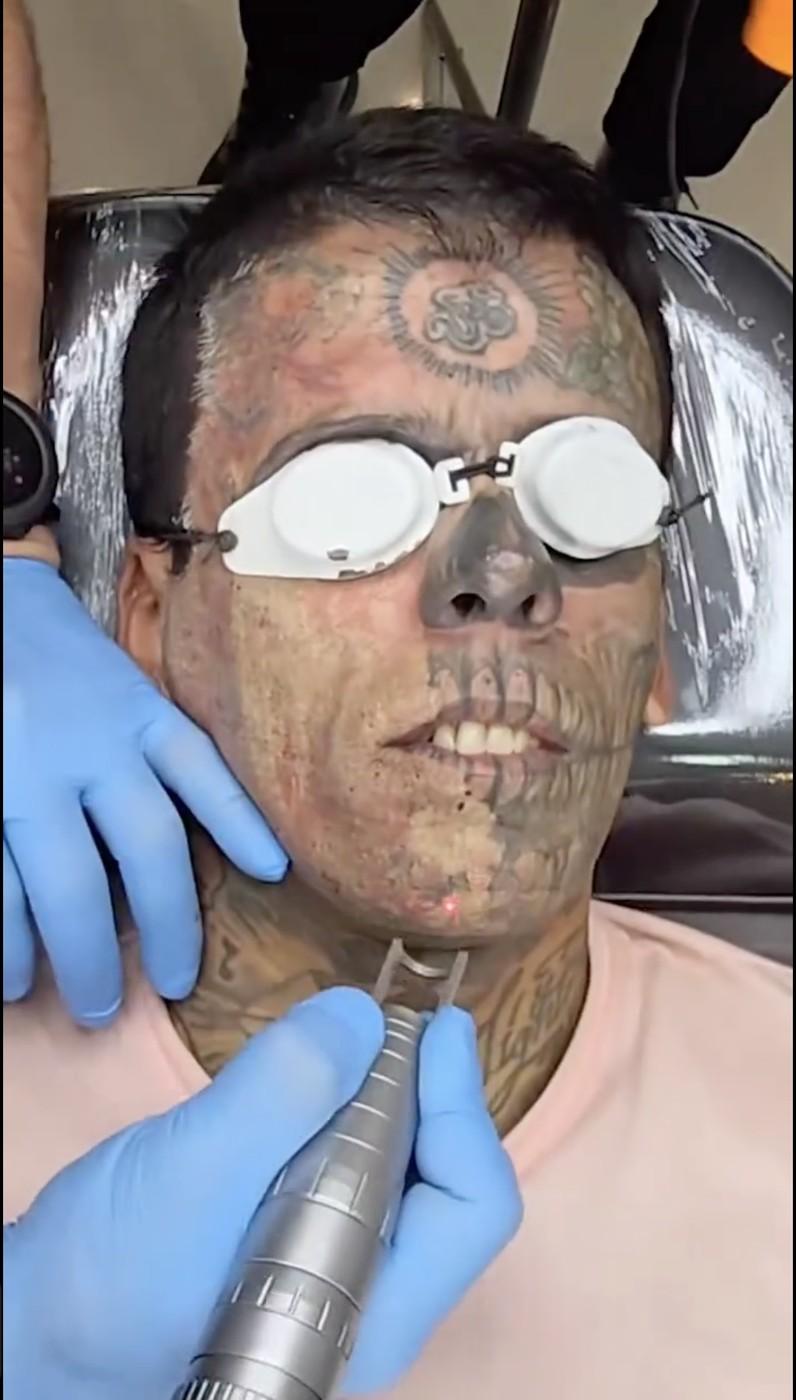 Leandro de Souza în timpul de procedurile de îndepărtare a tatuajelor