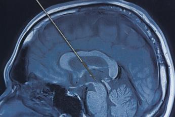 Implantul cerebral mai subțire decât un ac. Dispozitivul inedit care poate rezolva 3 probleme medicale în același timp