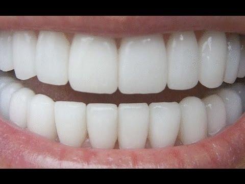 Video demonstrativ! Uite cum poți să-ți albești dintii, imediat, cu ingrediente naturale