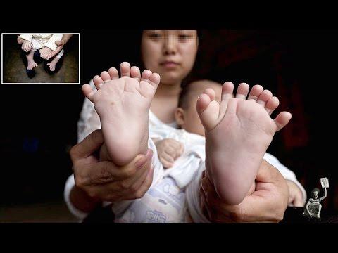 Un bebeluş s-a născut cu 31 de degete, deși ecografiile indicau că este sănătos. Cum arată micuțul! FOTO+VDEO